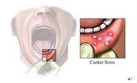 口腔溃疡的症状