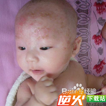 婴儿湿疹怎么治