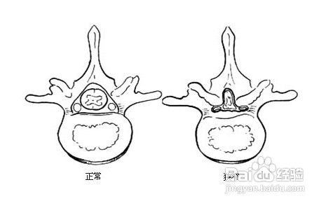 颈椎管狭窄的症状表现