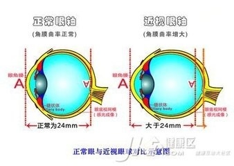 近视眼是怎么形成的