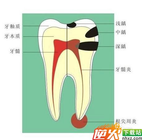 治牙和拔牙需要注意的几点事项